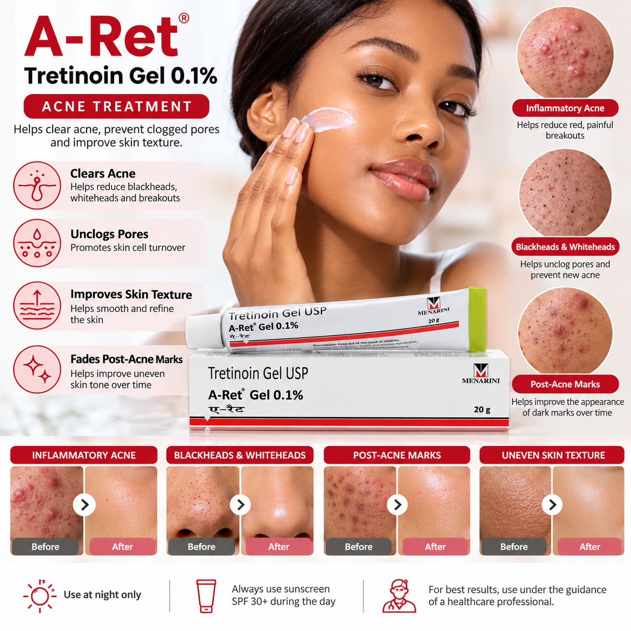 A-Ret Tretinoin Gel 0.1% – 20g
